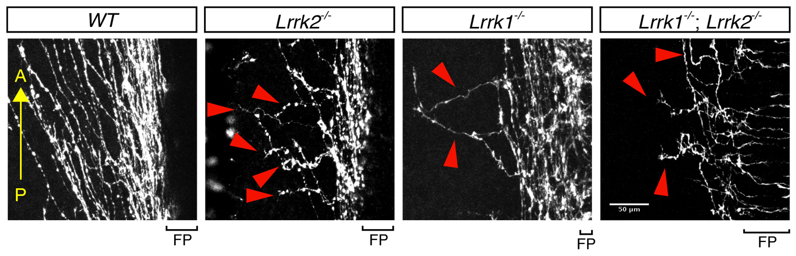 A set of neuronal images show missing spinal cord axons in cases missing LRRK genes versus normal growth of cases with LRRK genes.
